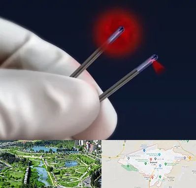 جراحی سینه با لیزر در بجنورد