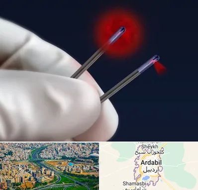 جراحی سینه با لیزر در اردبیل