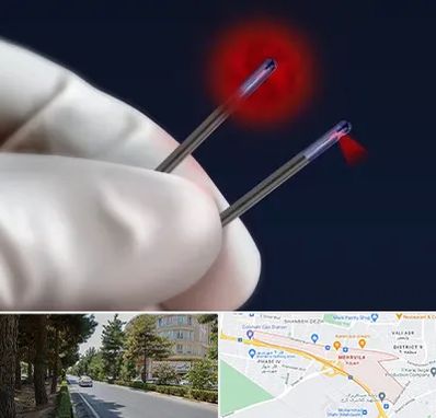 جراحی سینه با لیزر در مهرویلا کرج