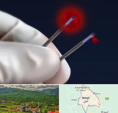 جراحی سینه با لیزر در آمل