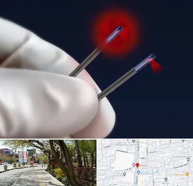 جراحی سینه با لیزر در خیابان توحید اصفهان