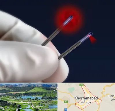 جراحی سینه با لیزر در خرم آباد