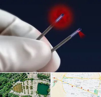 جراحی سینه با لیزر در وکیل آباد مشهد