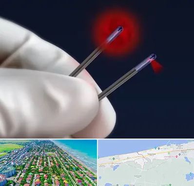 جراحی سینه با لیزر در فریدونکنار