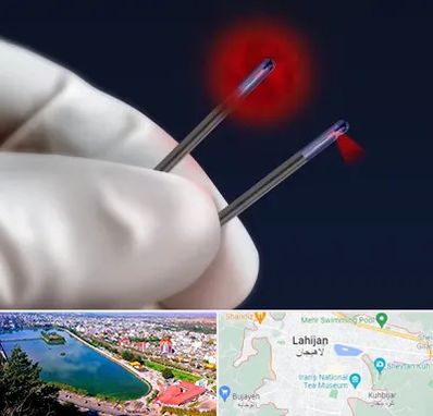 جراحی سینه با لیزر در لاهیجان