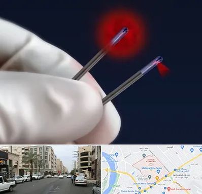 جراحی سینه با لیزر در زیتون کارمندی اهواز