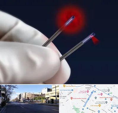 جراحی سینه با لیزر در خیابان ملاصدرا شیراز