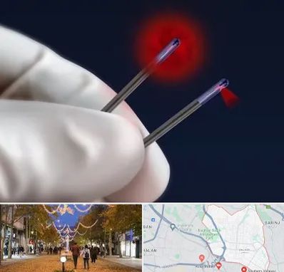 جراحی سینه با لیزر در ولیعصر ارومیه