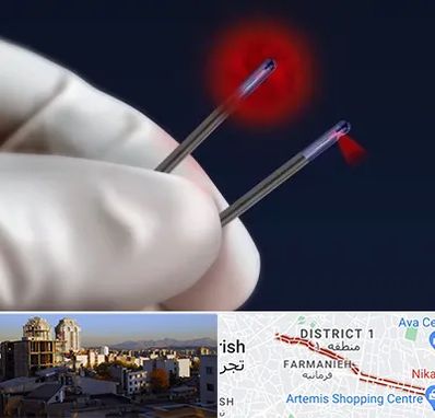 جراحی سینه با لیزر در فرمانیه 