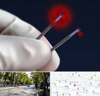 جراحی سینه با لیزر در میرداماد 