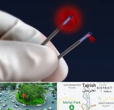 جراحی سینه با لیزر در تجریش 