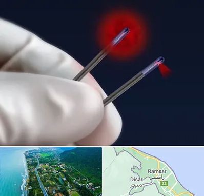 جراحی سینه با لیزر در رامسر