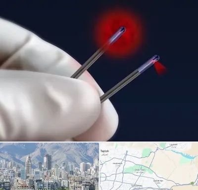 جراحی سینه با لیزر در شمال شرق تهران