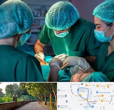 عمل کوچک کردن سینه در فلکه گاز رشت