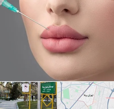کلینیک ژل لب روسی در تهران ویلا