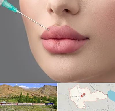 کلینیک ژل لب روسی در خاش