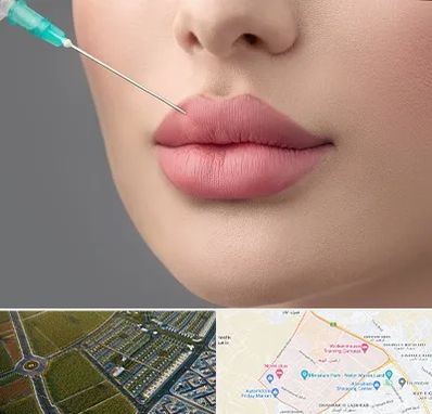 کلینیک ژل لب روسی در الهیه مشهد