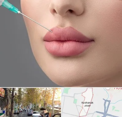 کلینیک ژل لب روسی در کاشانک