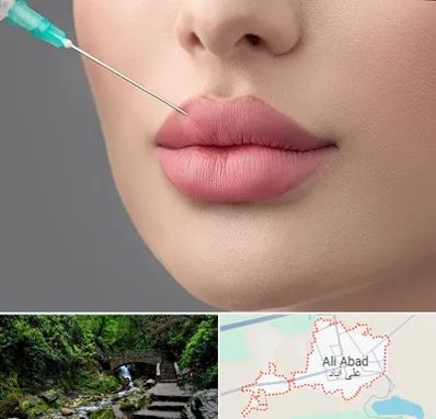 کلینیک ژل لب روسی در علی آباد کتول