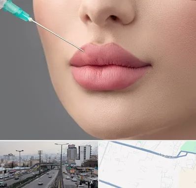 کلینیک ژل لب روسی در بلوار ارتش