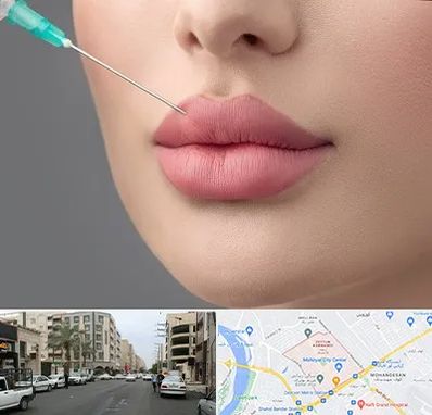 کلینیک ژل لب روسی در زیتون کارمندی اهواز