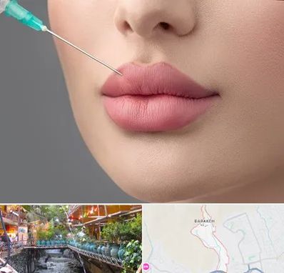 کلینیک ژل لب روسی در درکه