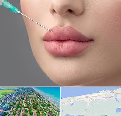 کلینیک ژل لب روسی در فریدونکنار