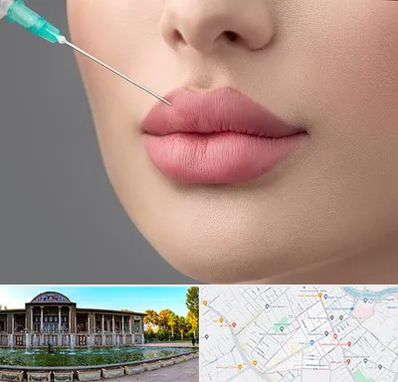 کلینیک ژل لب روسی در عفیف آباد شیراز