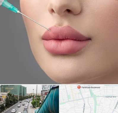 کلینیک ژل لب روسی در بلوار فرحزادی