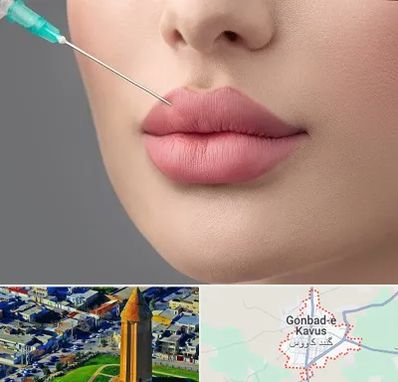 کلینیک ژل لب روسی در گنبد کاووس