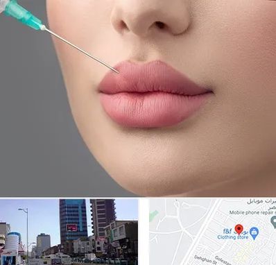 کلینیک ژل لب روسی در چهارراه طالقانی کرج