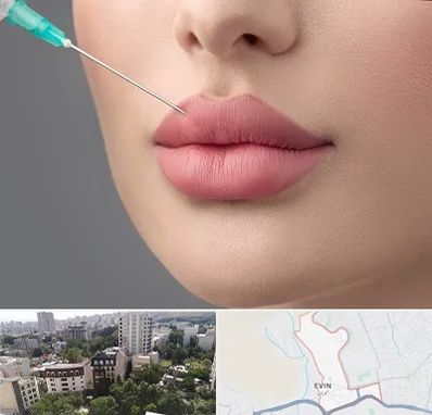 کلینیک ژل لب روسی در اوین