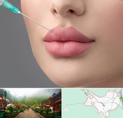 کلینیک ژل لب روسی در فومن