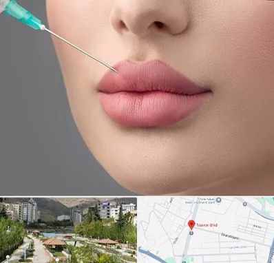 کلینیک ژل لب روسی در بلوار تعاون