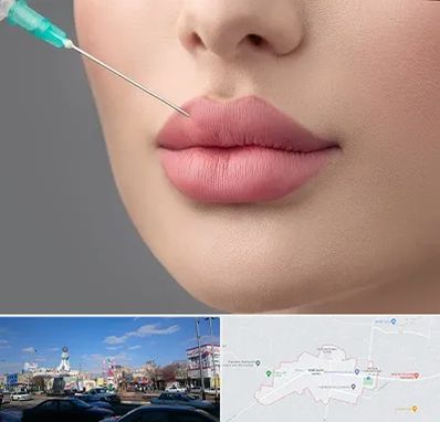 کلینیک ژل لب روسی در ماهدشت کرج