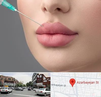 کلینیک ژل لب روسی در خیابان آذربایجان
