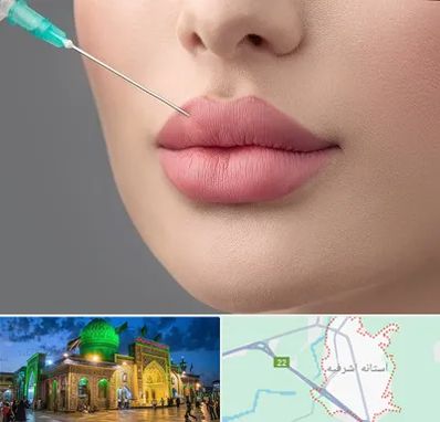 کلینیک ژل لب روسی در آستانه اشرفیه