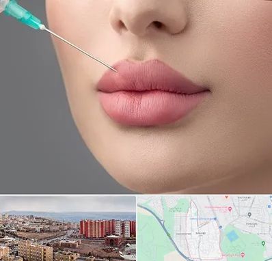 کلینیک ژل لب روسی در سهند تبریز