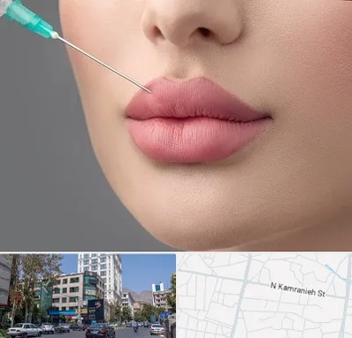 کلینیک ژل لب روسی در کامرانیه