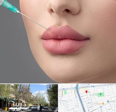 کلینیک ژل لب روسی در کوی فیروز تبریز