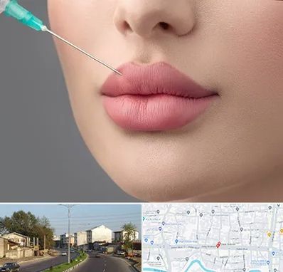 کلینیک ژل لب روسی در ضیابری رشت