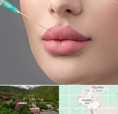 کلینیک ژل لب روسی در کلاله