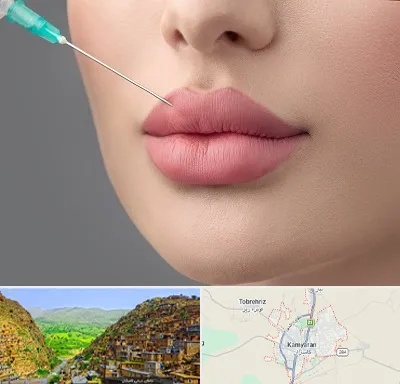 کلینیک ژل لب روسی در کامیاران