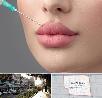 کلینیک ژل لب روسی در خیابان جمالزاده