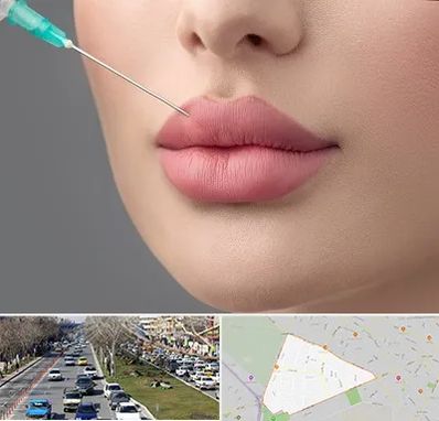 کلینیک ژل لب روسی در احمدآباد مشهد