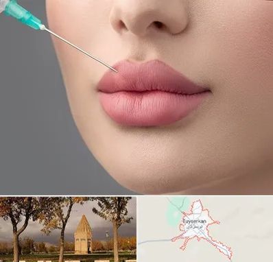 کلینیک ژل لب روسی در تویسرکان