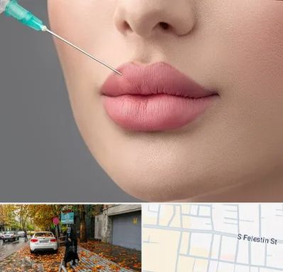 کلینیک ژل لب روسی در خیابان فلسطین