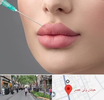 کلینیک ژل لب روسی در ولیعصر شهریار