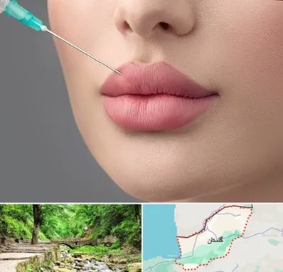 کلینیک ژل لب روسی در گلستان