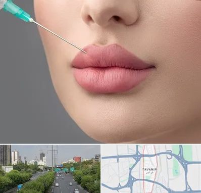 کلینیک ژل لب روسی در توانیر